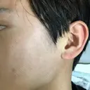 美容点滴・美容注射（美肌） / 美肌レーザー / フラクショナルレーザー（毛穴・ニキビ跡） 飯田橋駅前さくら坂クリニック DAY 5 サムネイル用