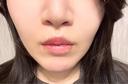 その他（鼻） / 人中短縮 / 鼻柱下降・鼻唇角形成（猫手術） Otus Clinic 【オータスクリニック】 AFTER サムネイル用