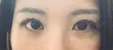 クマ治療 / 下まぶたの脂肪取り / ヒアルロン酸注入（目の下） / RF（高周波）たるみ治療 / その他（目元） ROOTS Clinic AFTER サムネイル用