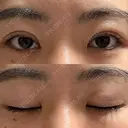二重埋没 WOM CLINIC GINZA （ワム クリニック ギンザ） DAY 7 サムネイル用