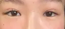 二重埋没 / 上まぶたの脂肪取り THE FIRST CLINIC 多摩センター院 AFTER サムネイル用