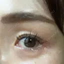 糸リフト / 目尻切開 / タレ目形成・グラマラスライン（切開） / ボトックス（あご） / ヒアルロン酸注入（あご） / ヒアルロン酸注入（鼻翼基部） Tokyo Tensei Clinic 新宿院 DAY 15 サムネイル用
