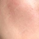 ピーリング（ニキビ・毛穴） / イオン導入 ルラ美容クリニック 札幌本院 AFTER サムネイル用