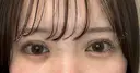 二重埋没 湘南美容クリニック 池袋東口院 DAY 7 サムネイル用