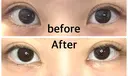 目頭切開 9BeautyClinic AFTER サムネイル用