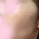 ピーリング（ニキビ・毛穴） KIMI CLINIC 形成・美容外科 DAY 0 サムネイル用