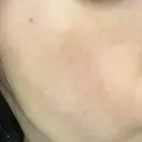 ルメッカ ルラ美容クリニック銀座院 AFTER サムネイル用