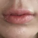 ヒアルロン酸注入（唇） / ボトックス（口角） ルラ美容クリニック 神戸院 AFTER サムネイル用