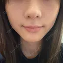 小鼻縮小（非切開） YBC横浜美容外科 池袋院 AFTER サムネイル用