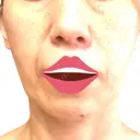 ボトックス（エラ・小顔） / ヒアルロン酸注入（頬） 新未来クリニック DAY 22 サムネイル用