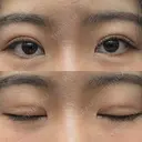 二重埋没 WOM CLINIC GINZA （ワム クリニック ギンザ） DAY 10 サムネイル用