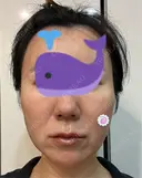 糸リフト Olino美容外科・美容皮膚科 DAY 14 サムネイル用
