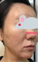 糸リフト Olino美容外科・美容皮膚科 DAY 14 サムネイル用