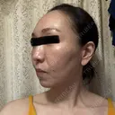 糸リフト / クマ治療 / 下まぶたの脂肪取り / 脂肪注入（肌） / こめかみ形成 / 脂肪注入（目の下） / ボトックス（あご） / ボトックス（首） 東京シンデレラ美容外科 池袋院 AFTER サムネイル用
