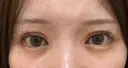 二重埋没 湘南美容クリニック 池袋東口院 DAY 9 サムネイル用