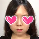 隆鼻術 / 鼻尖形成（切開） / 鼻中隔延長（切開） / 小鼻縮小（切開） ザ・プラス美容外科 DAY 180 サムネイル用