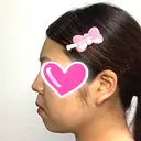 隆鼻術 / 鼻尖形成（切開） / 鼻中隔延長（切開） / 小鼻縮小（切開） ザ・プラス美容外科 DAY 180 サムネイル用