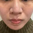 ベビーコラーゲン しのぶ皮膚科 DAY 0 サムネイル用