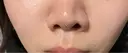 小鼻縮小（非切開） 形成外科と美容外科のクリニック池袋 DAY 0 サムネイル用
