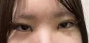二重埋没 / 目頭切開 / 上まぶたの脂肪取り 9BeautyClinic DAY 3 サムネイル用