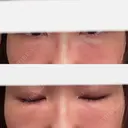 脂肪注入（目の下） 大塚美容形成外科 京都院 DAY 21 サムネイル用