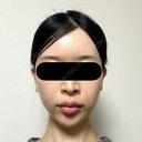 糸リフト / バッカルファット除去 / 脂肪吸引（顔） / ジョールファット除去 / ヒアルロン酸注入（額） / ヒアルロン酸注入（頬） BLINC CLINIC （ブリンク クリニック） DAY 30 サムネイル用
