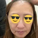 ボトックス（額） / ピーリング（ニキビ・毛穴） / イオン導入 CHARIS BEAUTY CLINIC AFTER サムネイル用