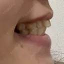 矯正（マウスピース） SF六本木東京 dental orthodontics DAY 100 サムネイル用