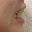 矯正（マウスピース） SF六本木東京 dental orthodontics DAY 163 サムネイル用