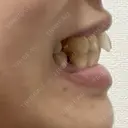 矯正（マウスピース） SF六本木東京 dental orthodontics DAY 227 サムネイル用