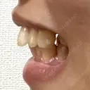 矯正（マウスピース） SF六本木東京 dental orthodontics DAY 361 サムネイル用