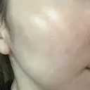 ピーリング（ニキビ・毛穴） KIMI CLINIC 形成・美容外科 DAY 4 サムネイル用