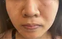 ベビーコラーゲン しのぶ皮膚科 DAY 1 サムネイル用