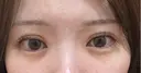 二重埋没 湘南美容クリニック 池袋東口院 DAY 11 サムネイル用