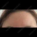 マイクロボトックス BAO CLINIC 心斎橋院 AFTER サムネイル用