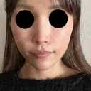 ヒアルロン酸注入（頬） ルラ美容クリニック 仙台院 / ルラスキンクリニック 仙台院 AFTER サムネイル用