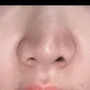 小鼻縮小（非切開） 形成外科と美容外科のクリニック池袋 DAY 2 サムネイル用