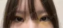 二重埋没 / 目頭切開 / 上まぶたの脂肪取り 9BeautyClinic DAY 5 サムネイル用