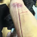 脂肪吸引（顔） / 脂肪吸引（二の腕） / 脂肪吸引（脚） / 脂肪吸引（お腹） / 脂肪吸引（お尻） / 脂肪吸引（腰） / 脂肪吸引（背中） / 脂肪吸引（肩） ヴェルトラクリニック 新宿院 DAY 3 サムネイル用