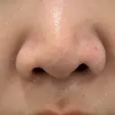 小鼻縮小（非切開） 形成外科と美容外科のクリニック池袋 AFTER サムネイル用