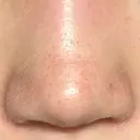 隆鼻術 / 鼻尖形成（切開） / 軟骨移植 RIVER CLINIC（リバークリニック） DAY 11 サムネイル用