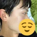美容点滴・美容注射（美肌） / 美肌レーザー / フラクショナルレーザー（毛穴・ニキビ跡） 飯田橋駅前さくら坂クリニック DAY 5 サムネイル用