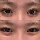 ヒアルロン酸注入（涙袋） / ボトックス（エラ・小顔） フィラークリニック 大阪心斎橋院 DAY 0 サムネイル用