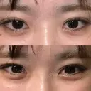 ヒアルロン酸注入（涙袋） / ボトックス（エラ・小顔） フィラークリニック 大阪心斎橋院 AFTER サムネイル用