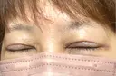 眼瞼下垂（切開） 博多もへじのクリニック DAY 7 サムネイル用
