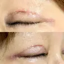 眼瞼下垂（切開） 博多もへじのクリニック DAY 7 サムネイル用