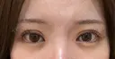 二重埋没 湘南美容クリニック 池袋東口院 DAY 10 サムネイル用
