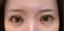 二重埋没 湘南美容クリニック 池袋東口院 DAY 12 サムネイル用