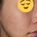 ニードルRF（ポテンツァなど） / ポテンツァ BAO CLINIC 神戸院 DAY 2 サムネイル用