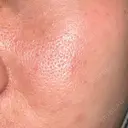 ニードルRF（ポテンツァなど） / ポテンツァ BAO CLINIC 神戸院 AFTER サムネイル用